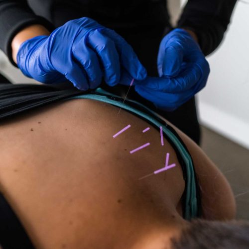 Acupuncture and Dry Needling – What’s The Difference and Which One Is For Me?